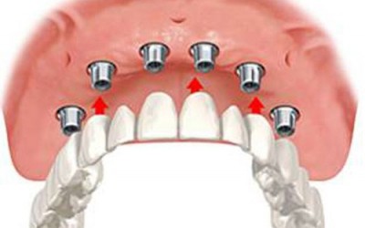 Implantálás
