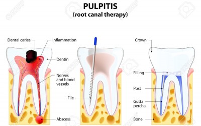 Endodoncia, gyökérkezelés